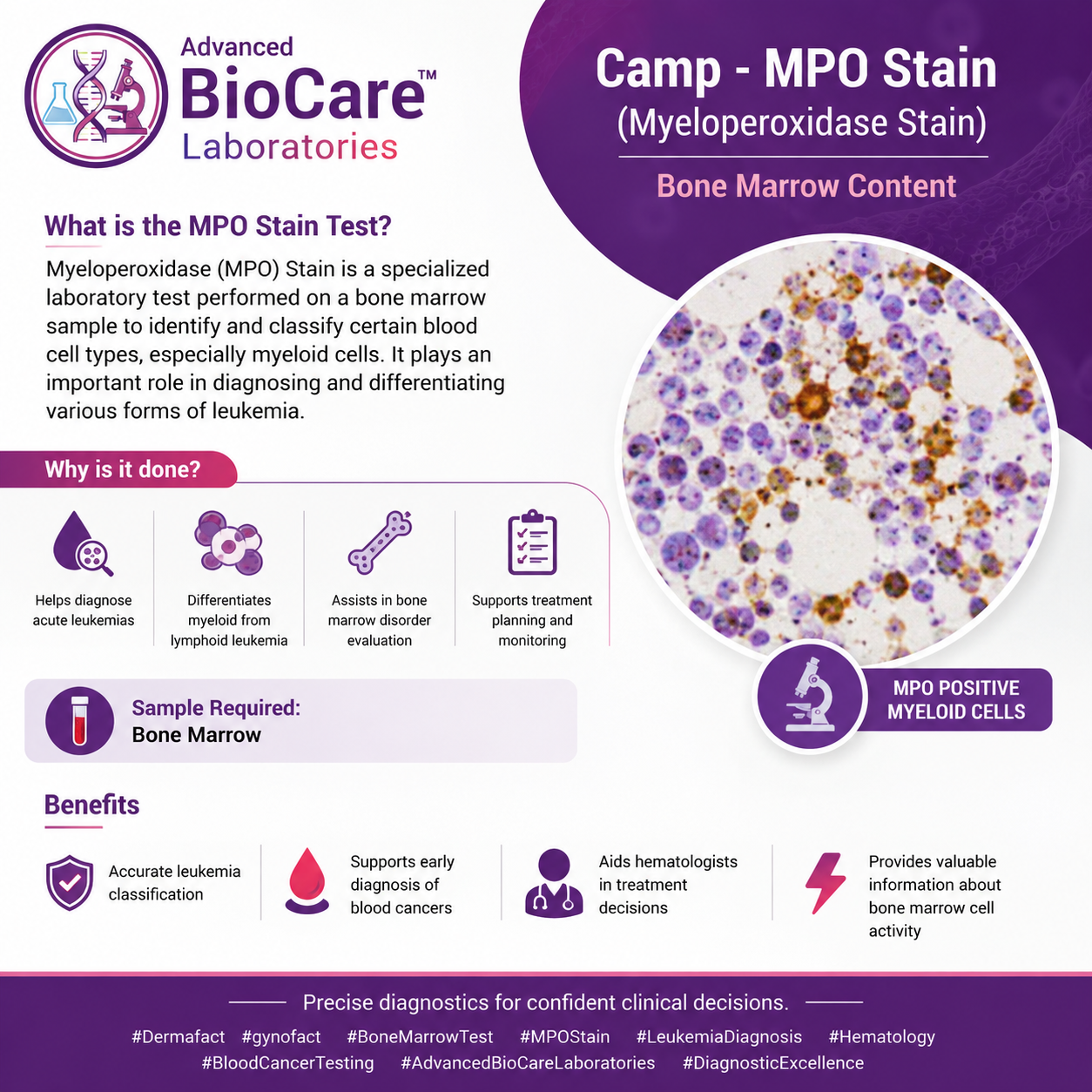 MPO stain (Myeloperoxidase Stain), Bone Marrow
