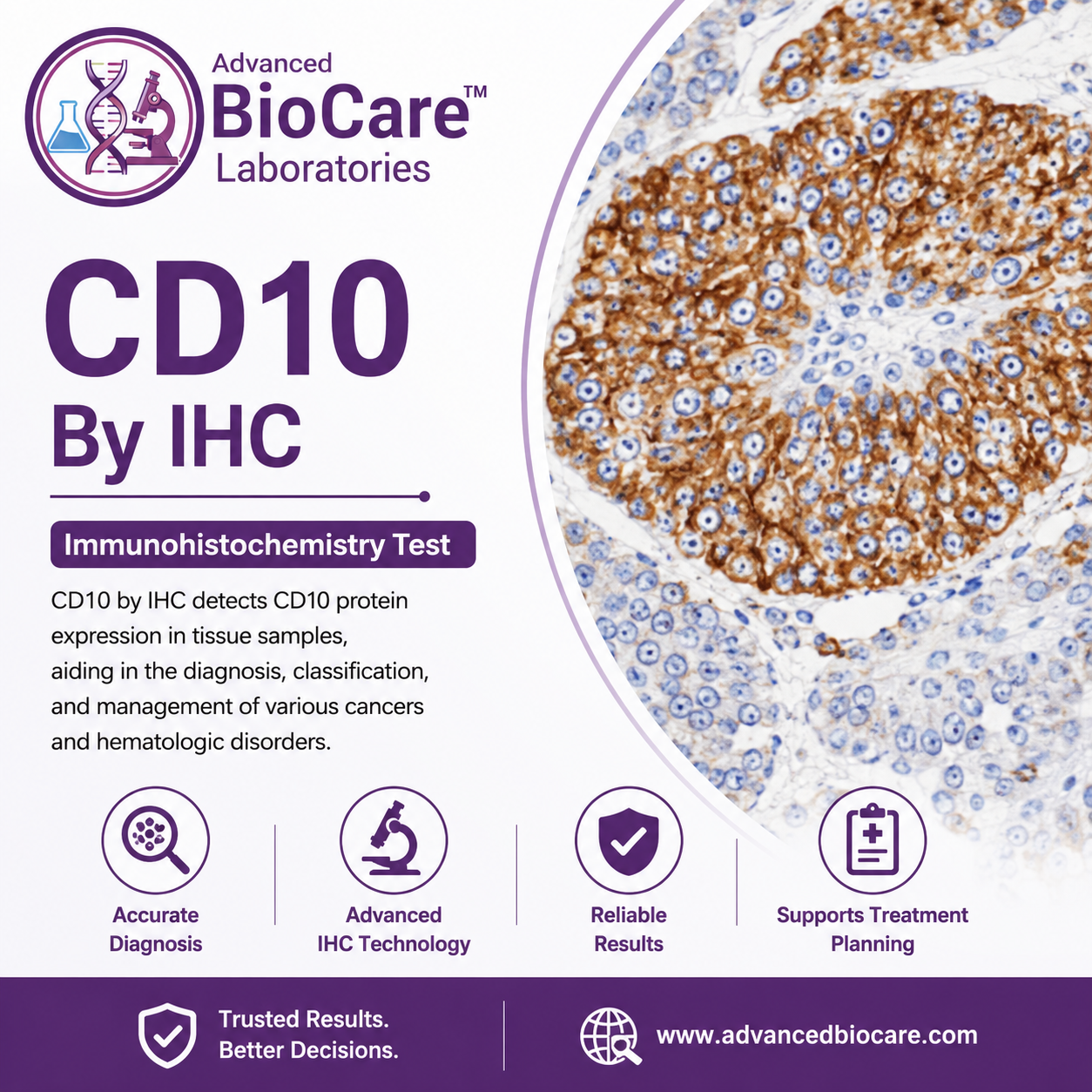 CD10 by IHC