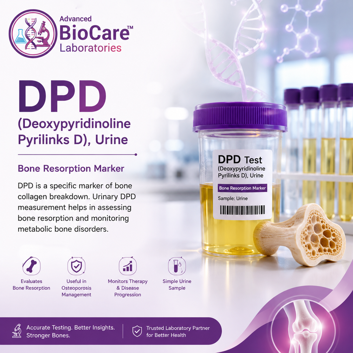 DPD (Deoxypyridinoline Pyrilinks D), Urine