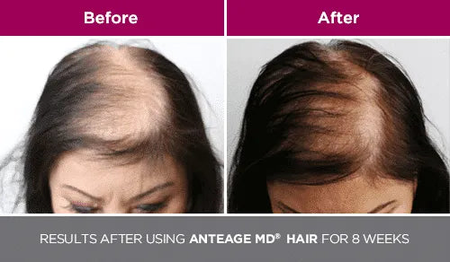 AnteAGE MD® Home Hair System – Hair Serum Refill (30ml)