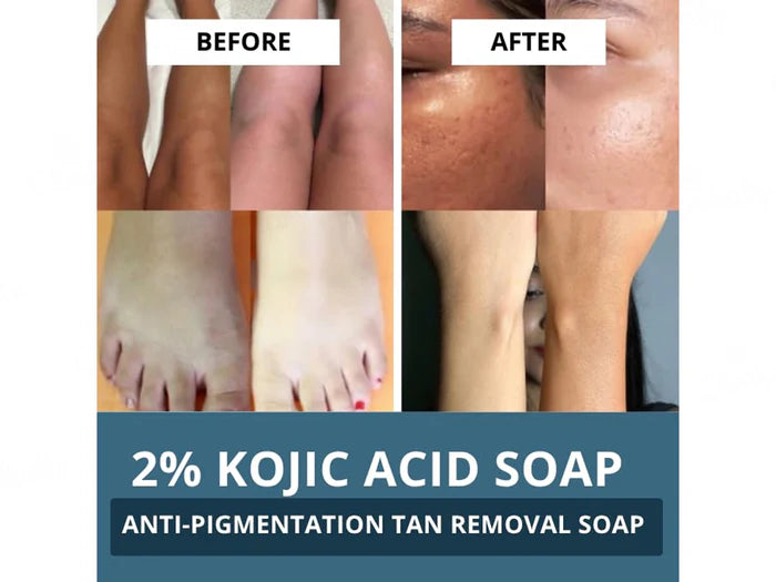Bake 2% Kojic Acid + Alpha Arbutin Anti-Pigmentation Soap