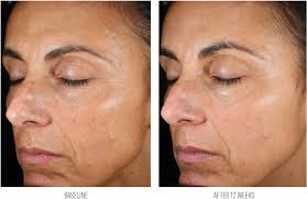 AnteAGE® Hyaluronic Acid Glide