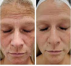 AnteAGE MD® Brightener – Advanced Pigment Correction Serum 30ml