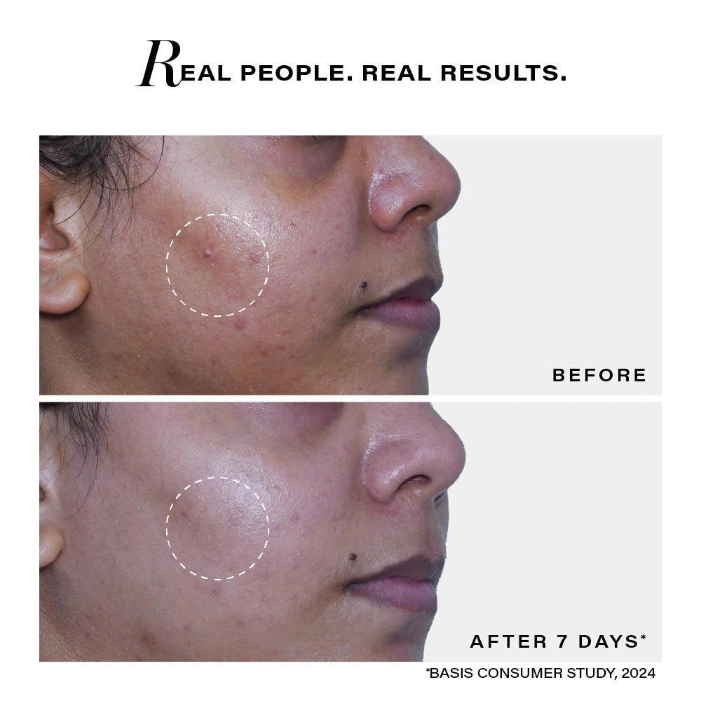 NOVOLOGY ACNE DEEP CLEARING CLEANSER, 150G 0.35% Thymol + Terpineol